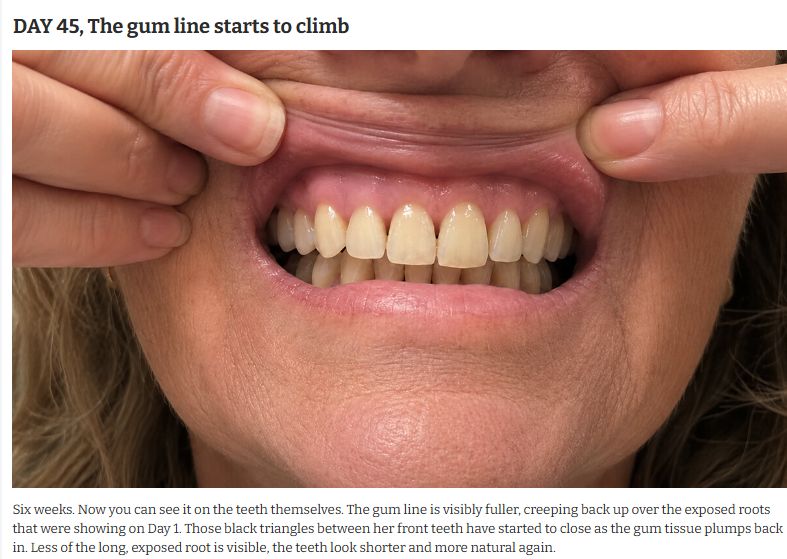 Day 45 Gum Line Climbs